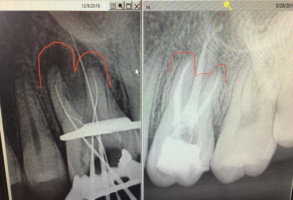 root canal west covina