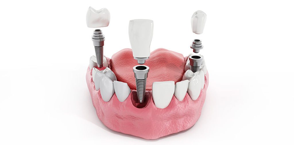 dental implant west covina