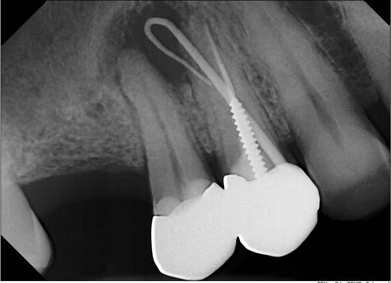 Before-Healing A fistula after Root Canal