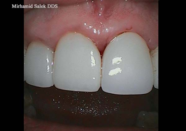 After-Dental Crown