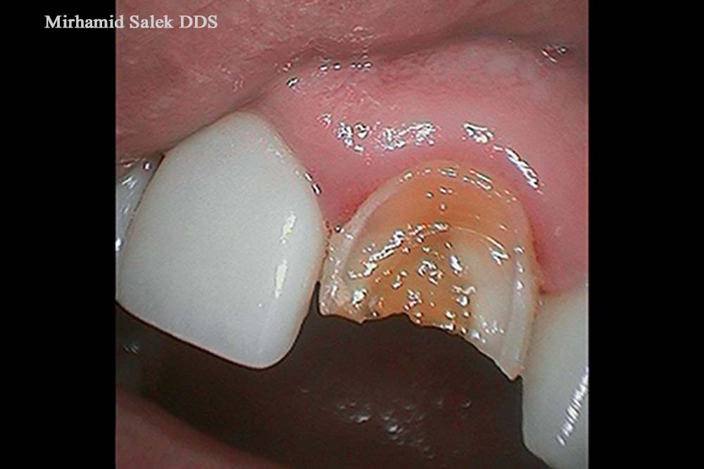 Before-Dental Crown