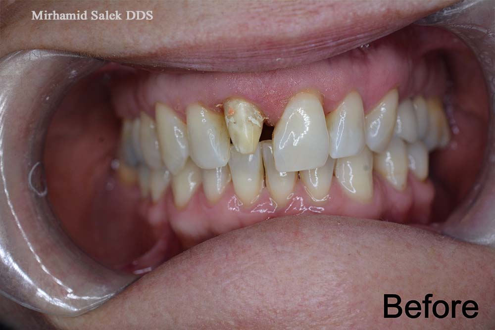 Before-Dental Crown 