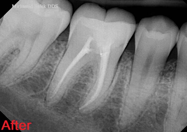 After-Root Canal