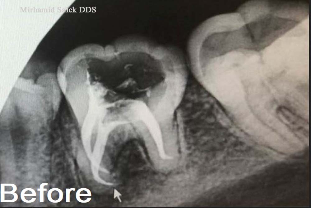 Before-Build up After a Root Canal