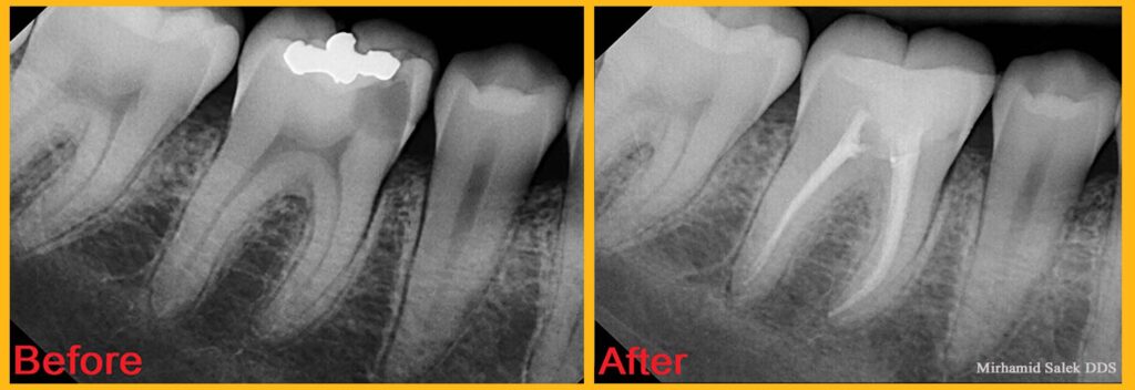 root canal before and after photos