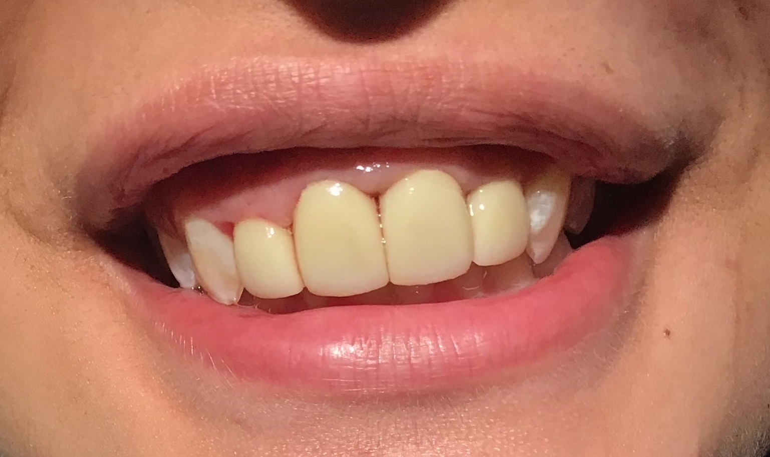 After-Front Crowns