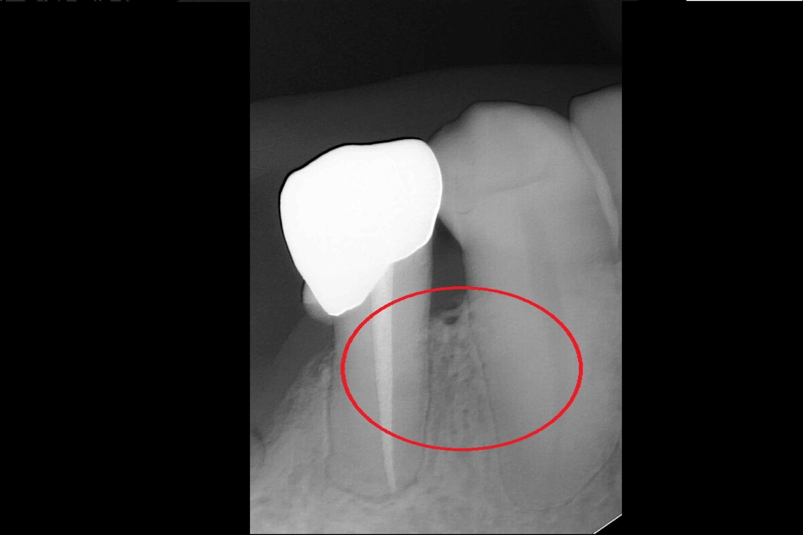 After-Healing after Root Canal