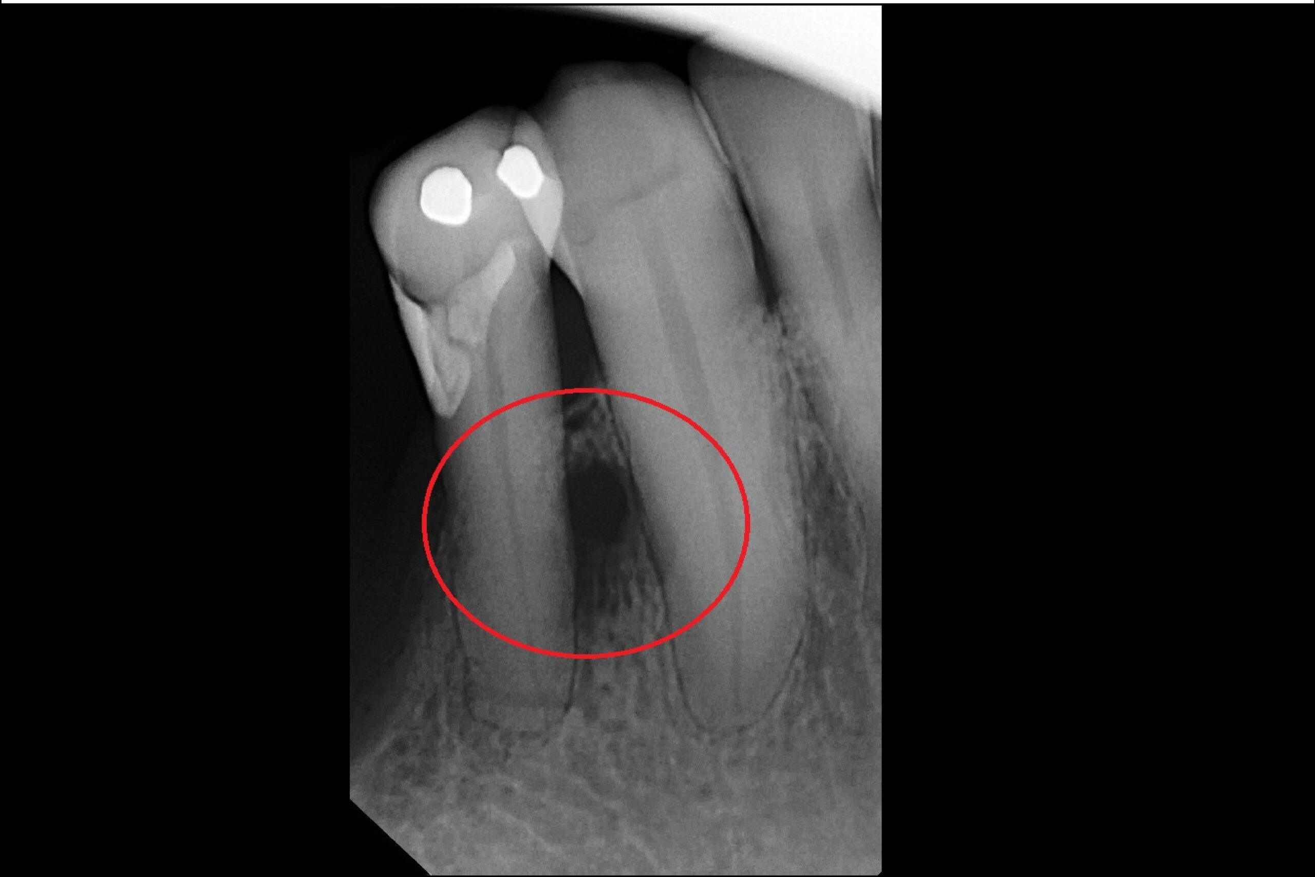 Before-Healing after Root Canal